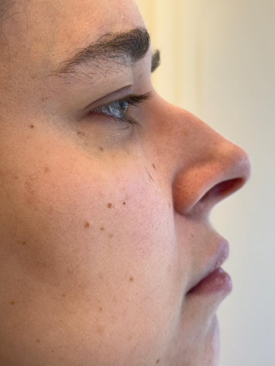 Antes — Harmonização Facial Perfil