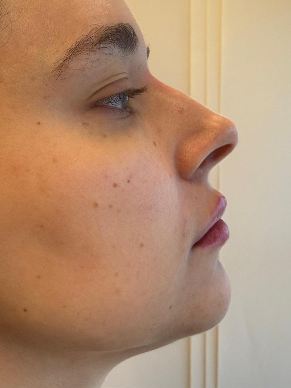 Depois — Harmonização Facial Perfil