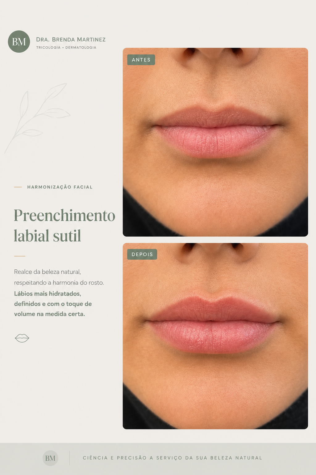 Depois — Preenchimento Labial